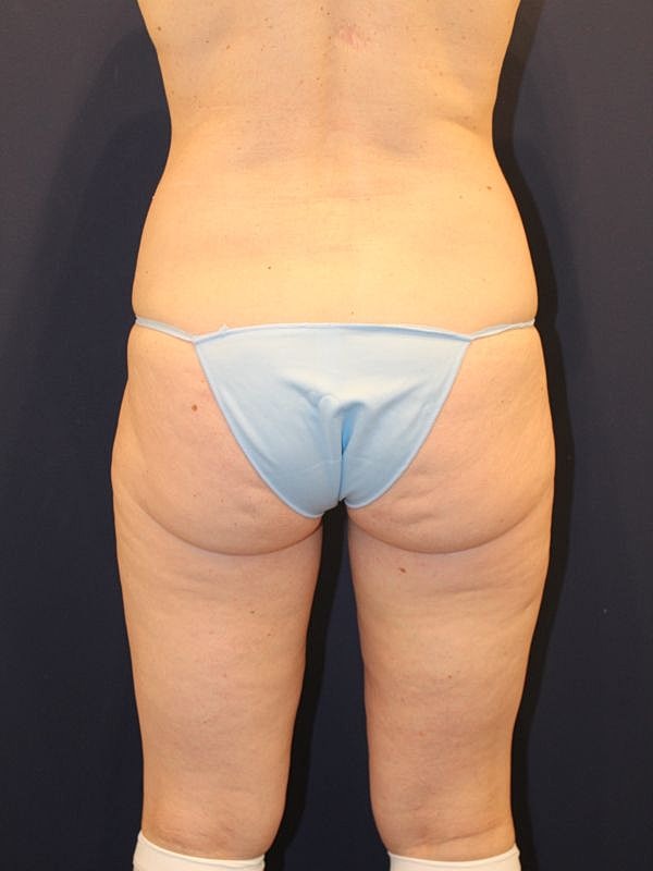 Liposuction Gallery Before & After
