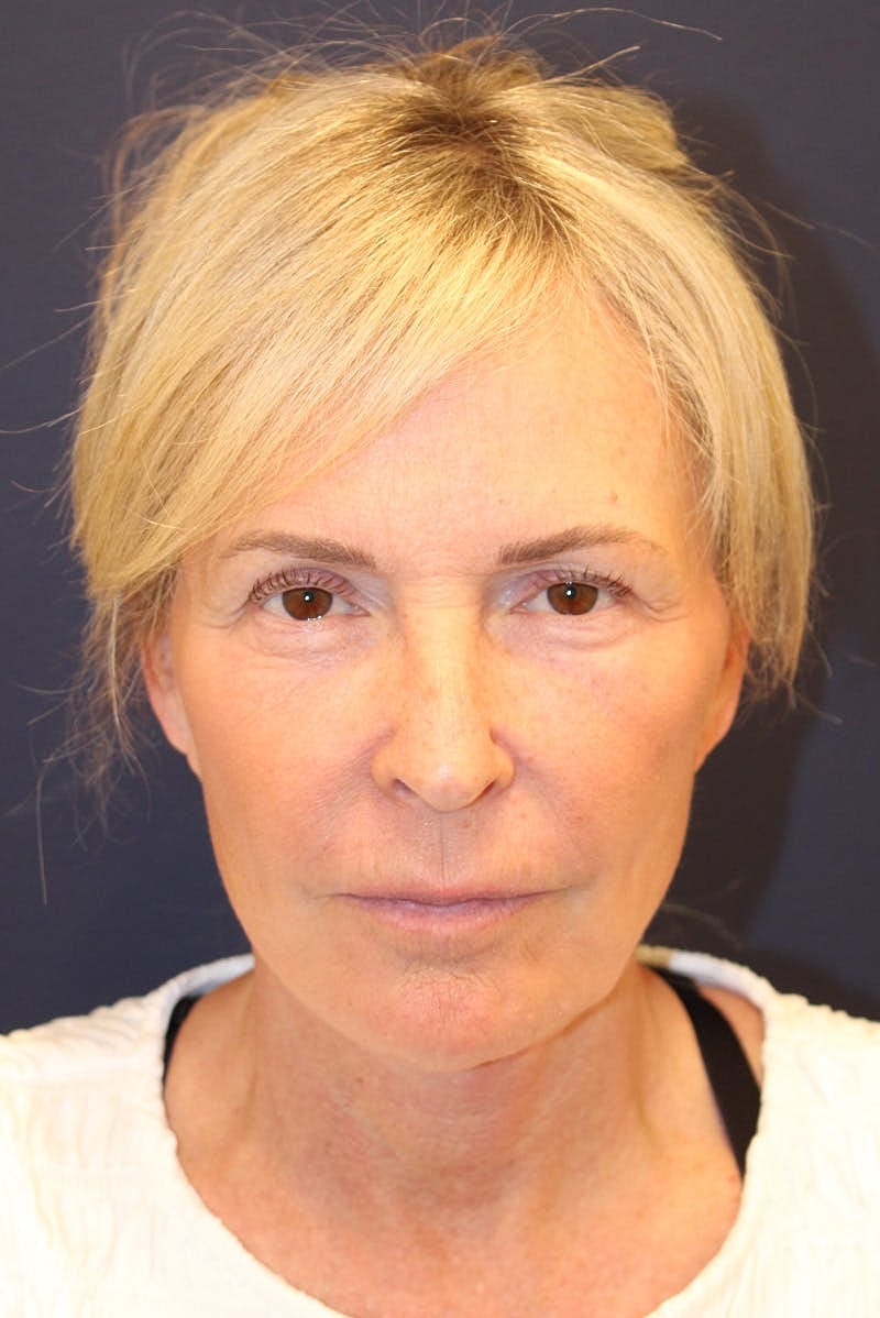 Facelift Before & After