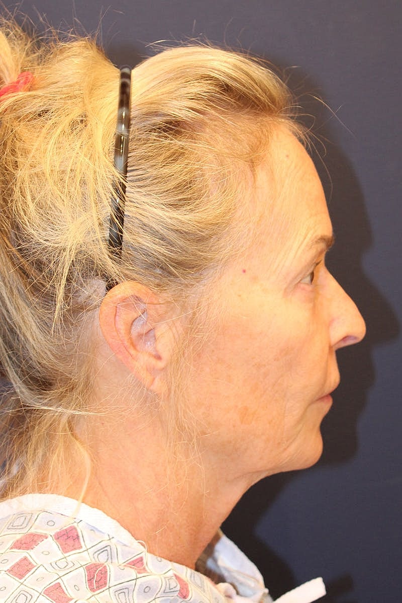 Facelift Before & After