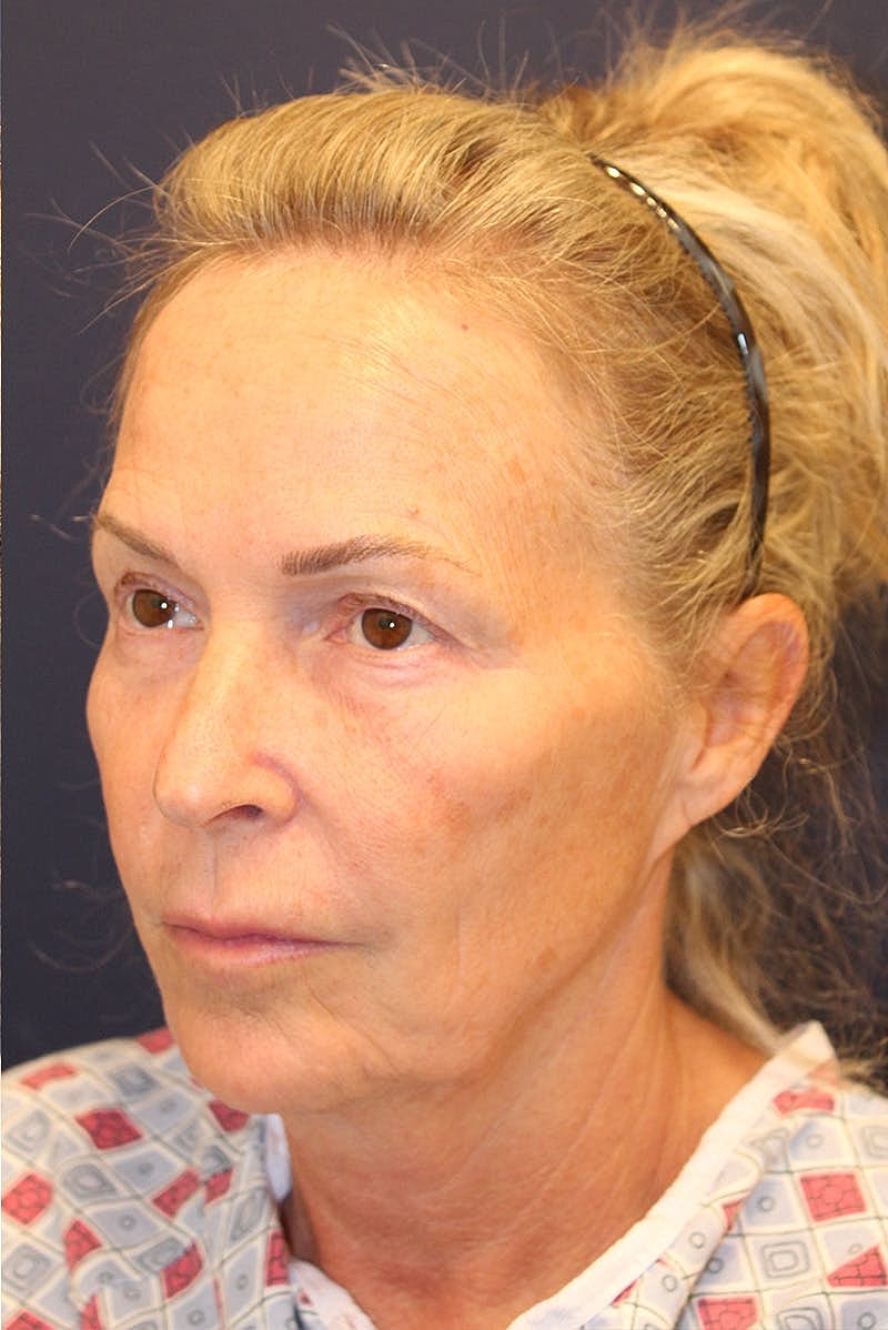 Facelift Before & After