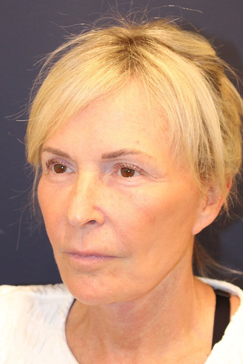 Facelift Before & After