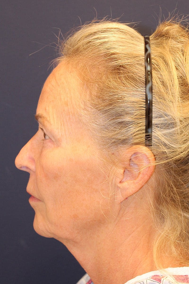Facelift Before & After