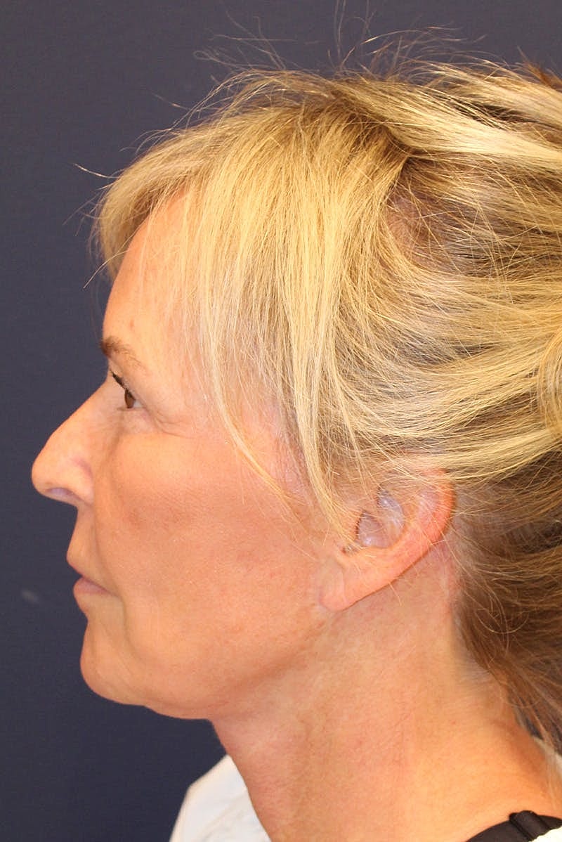Facelift Before & After