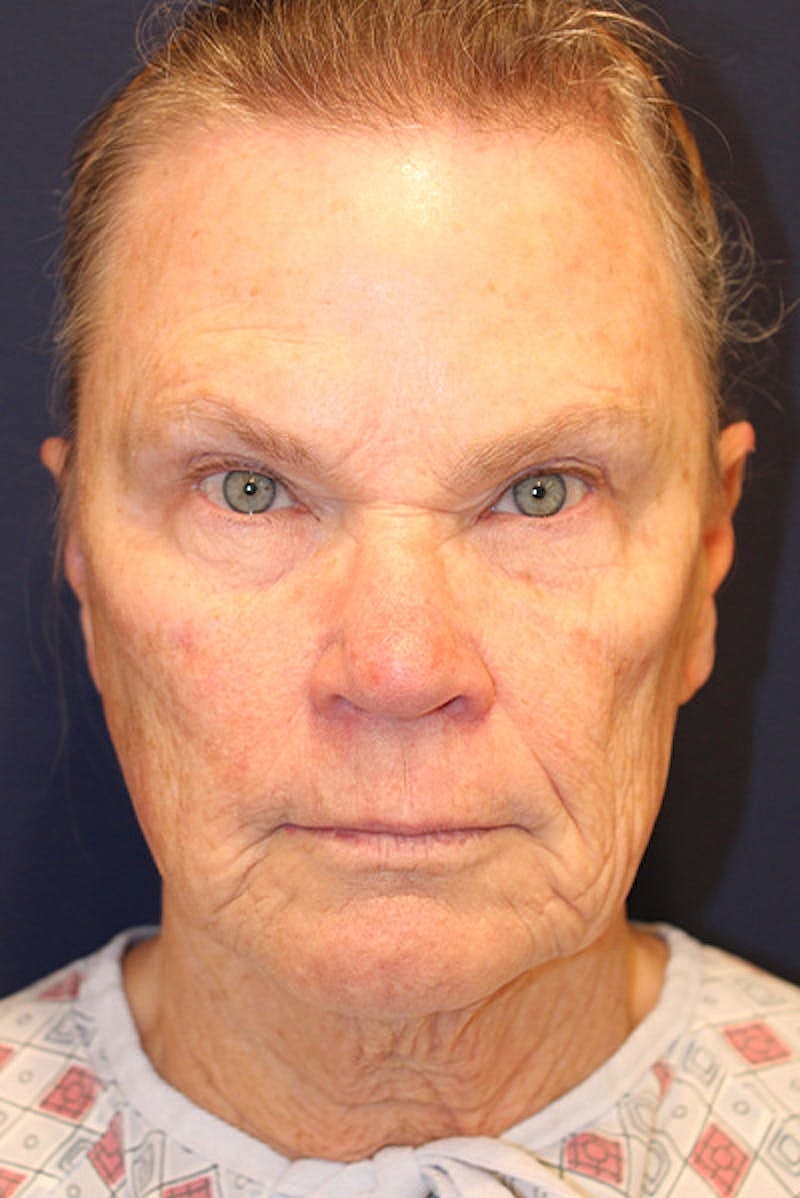 Facelift Before & After