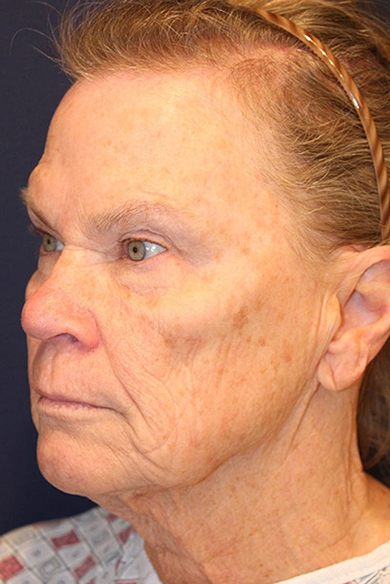 Facelift Before & After