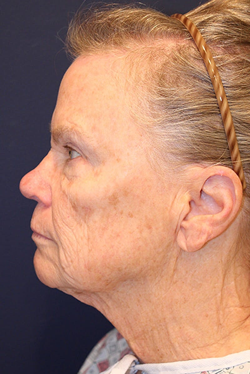 Facelift Before & After