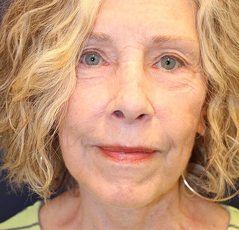 Facelift Before & After