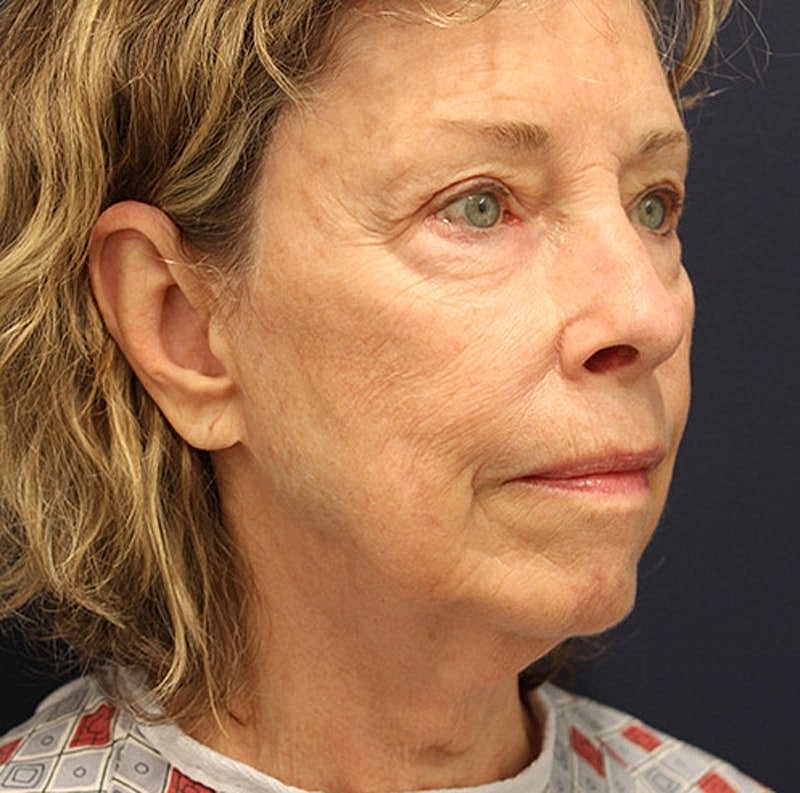 Facelift Before & After