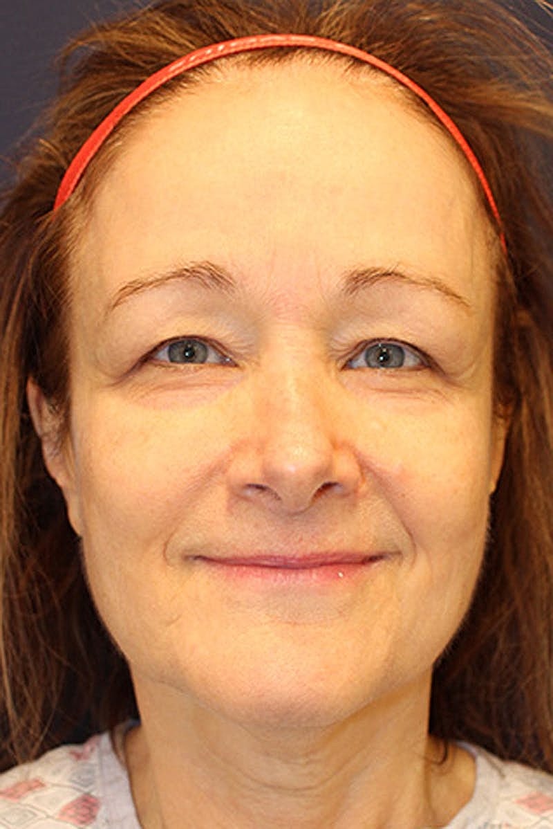 Facelift Before & After