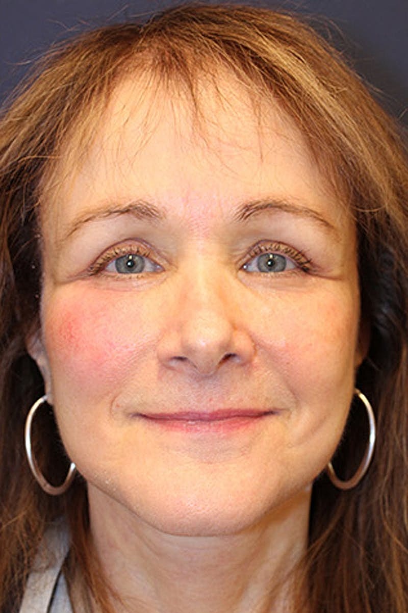 Facelift Before & After