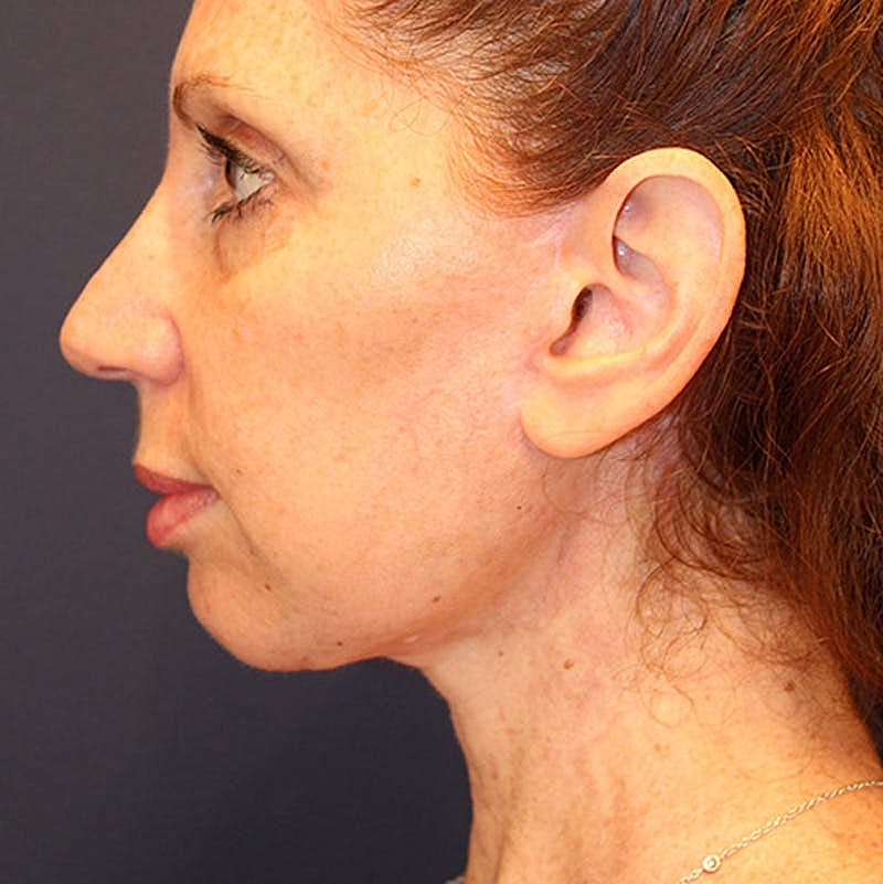 Facelift Before & After