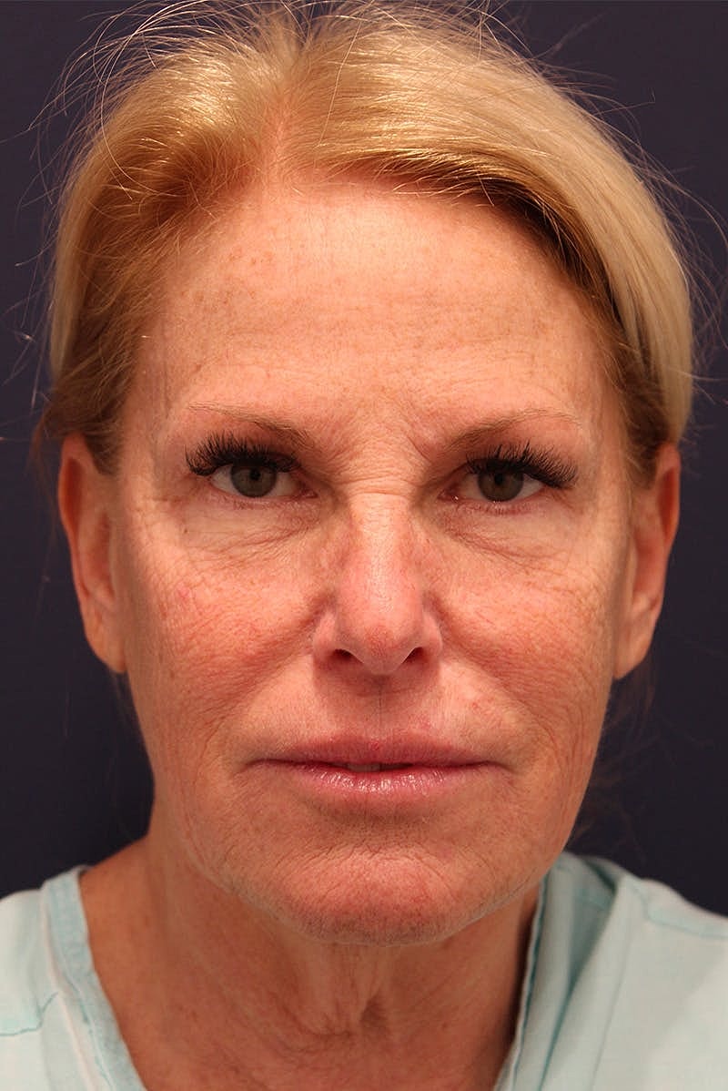 Facelift Before & After