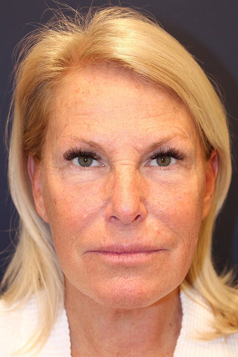 Facelift Before & After