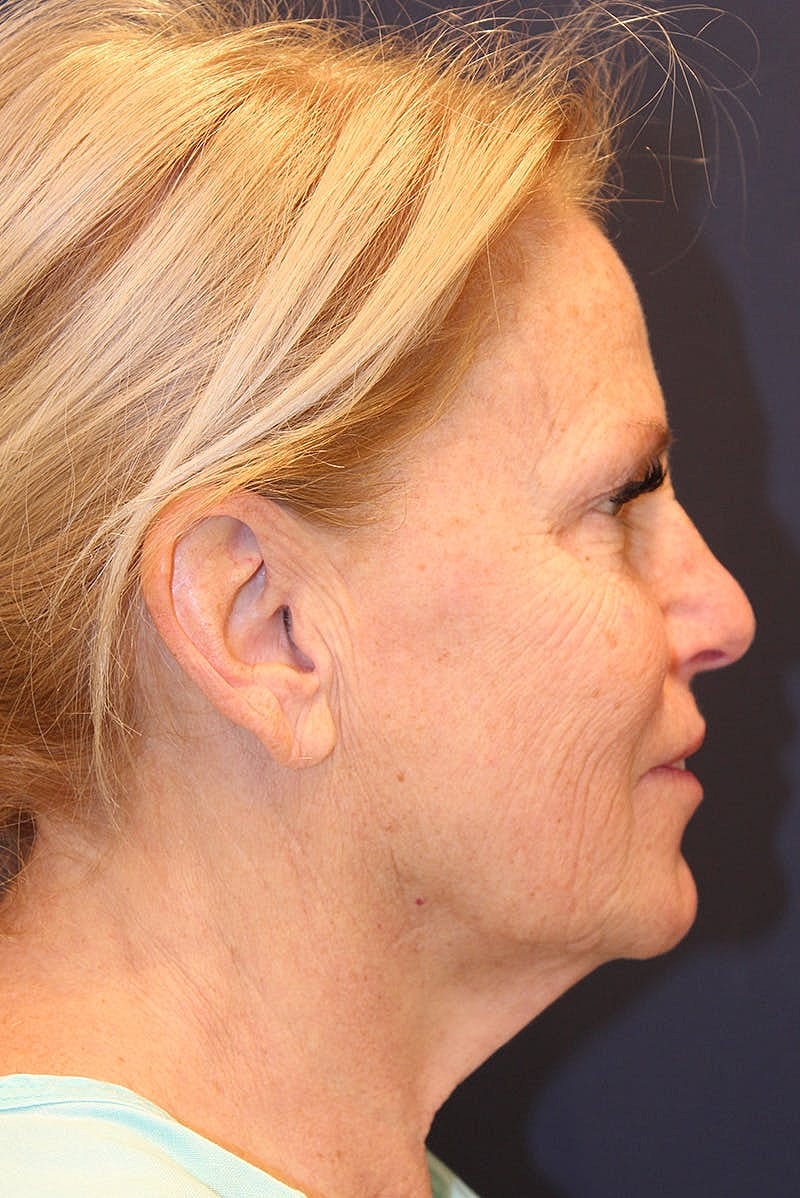 Facelift Before & After