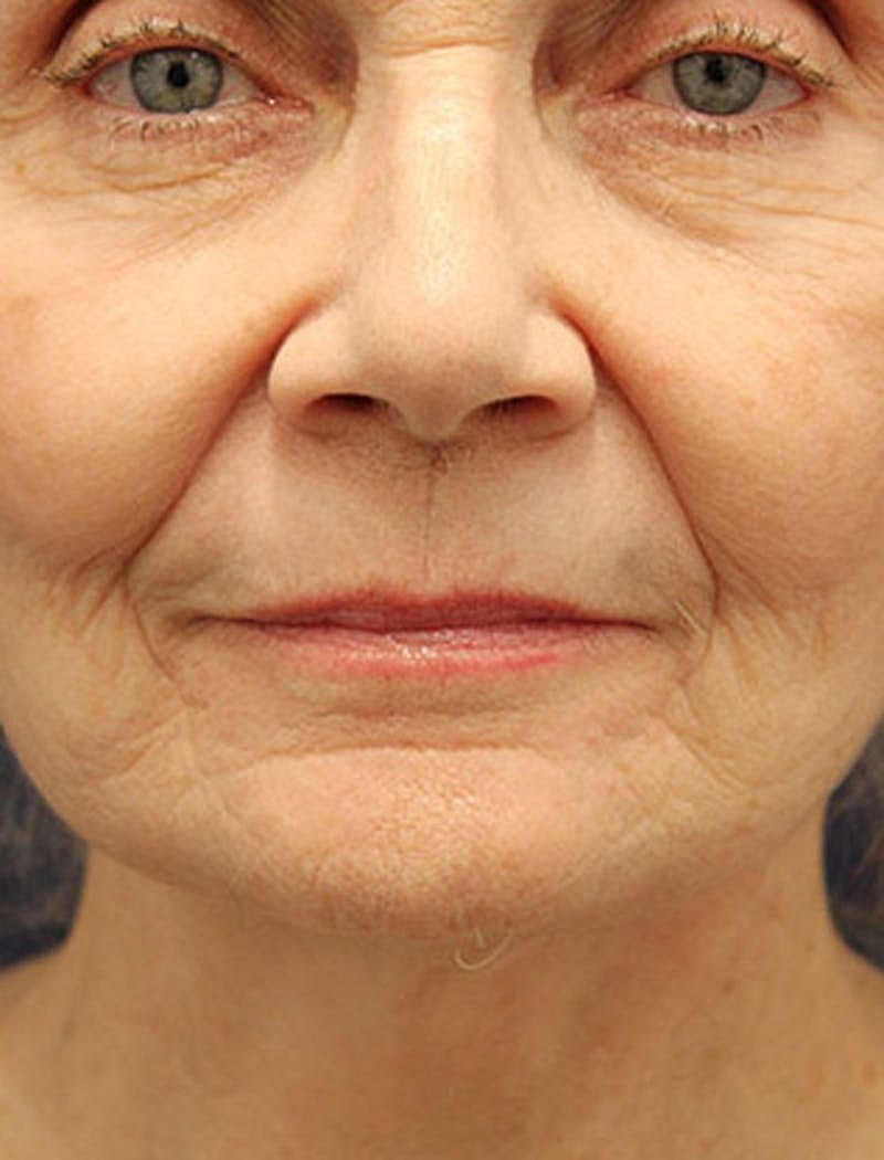 Facelift Before & After