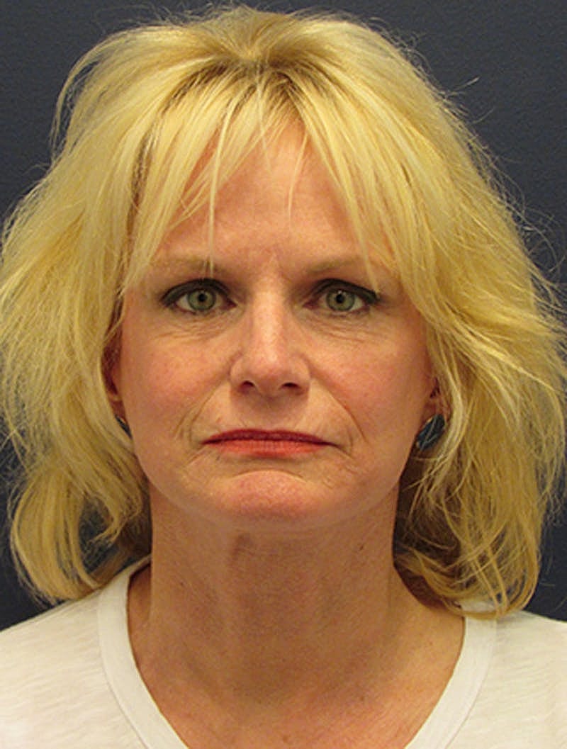 Facelift Before & After