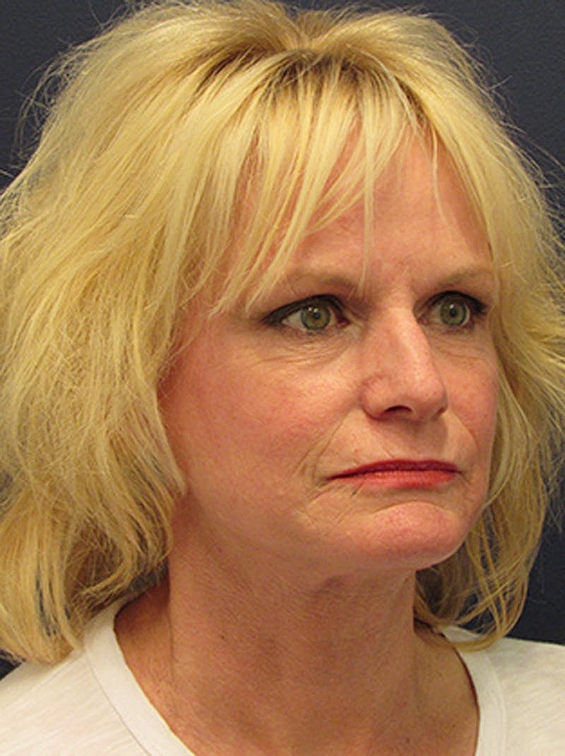 Facelift Before & After