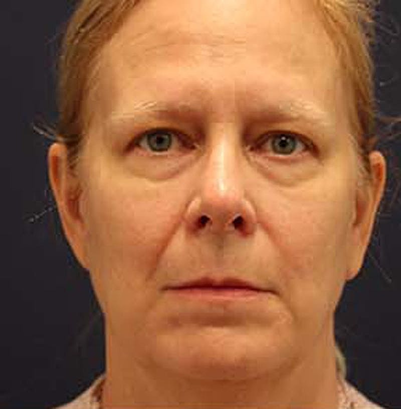 Facelift Before & After