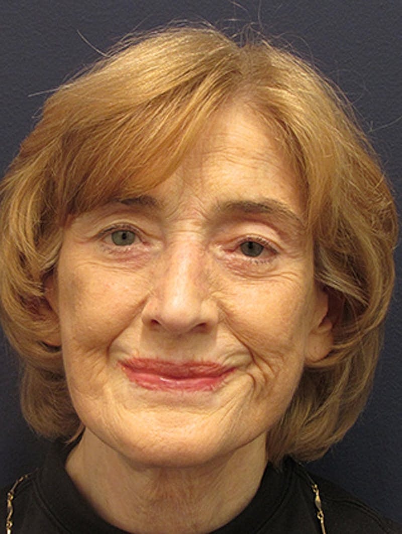 Facelift Before & After