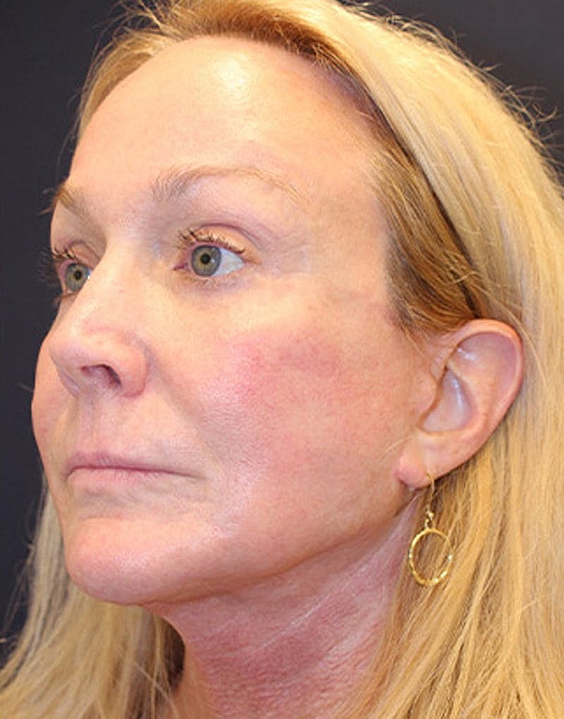 Facelift Before & After