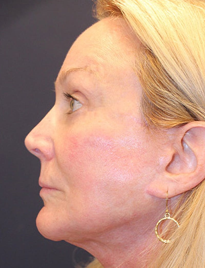 Facelift Before & After