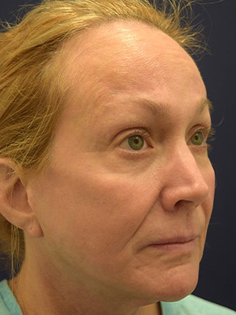 Facelift Before & After