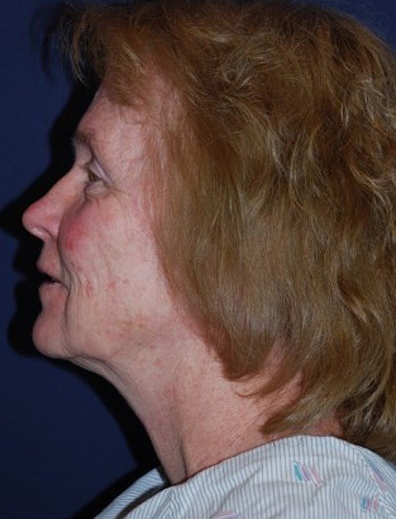 Facelift Before & After