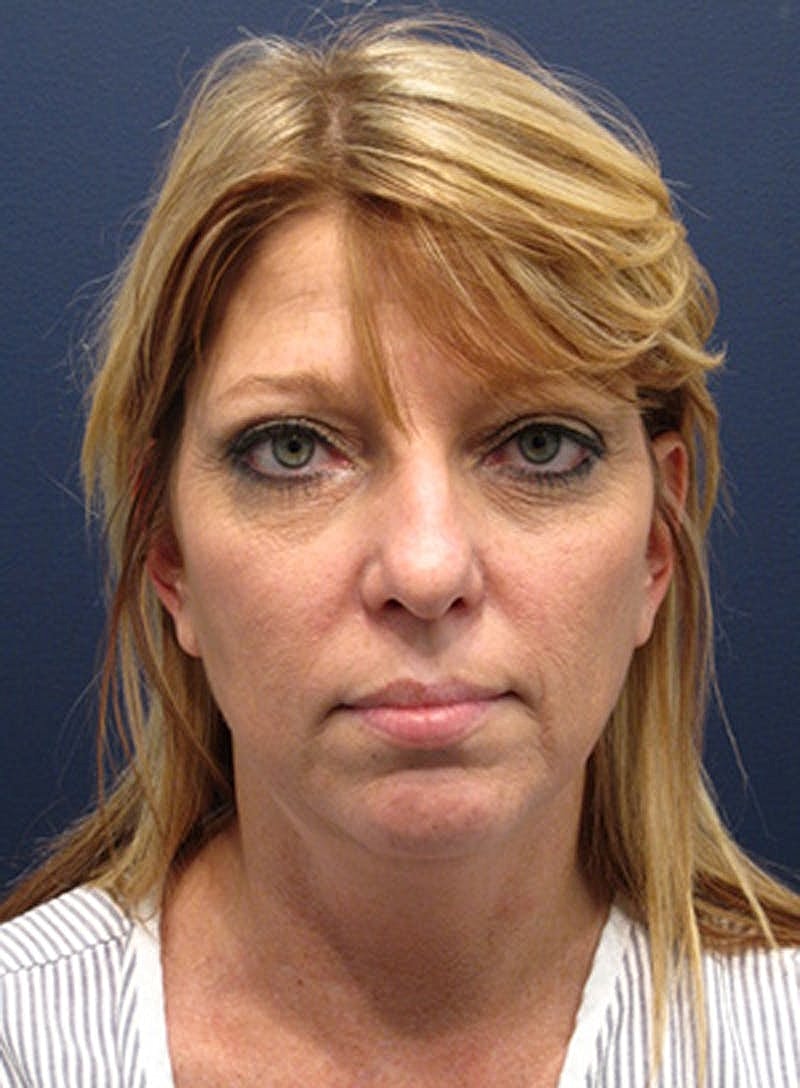 Facelift Before & After