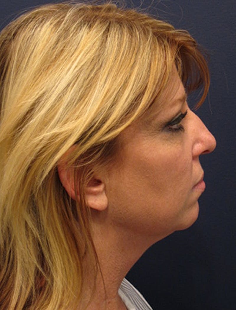 Facelift Before & After