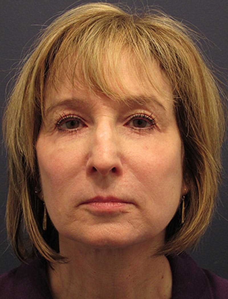 Facelift Before & After