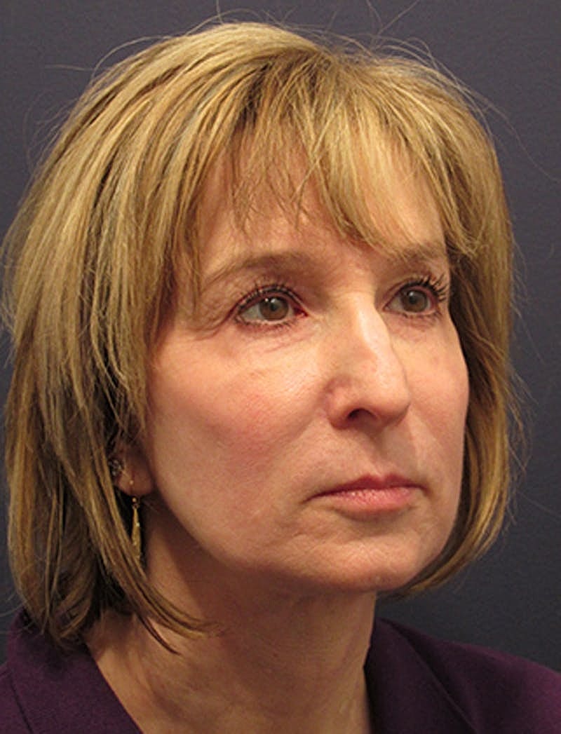 Facelift Before & After