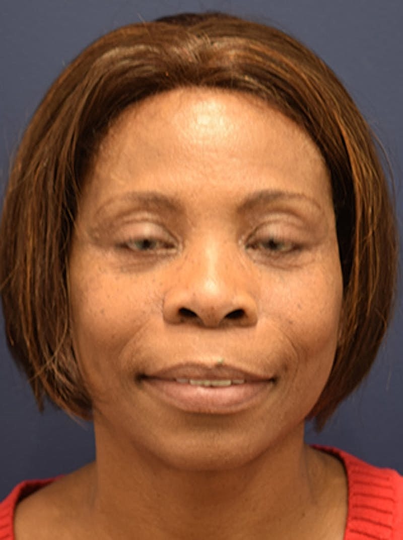 Facelift Before & After