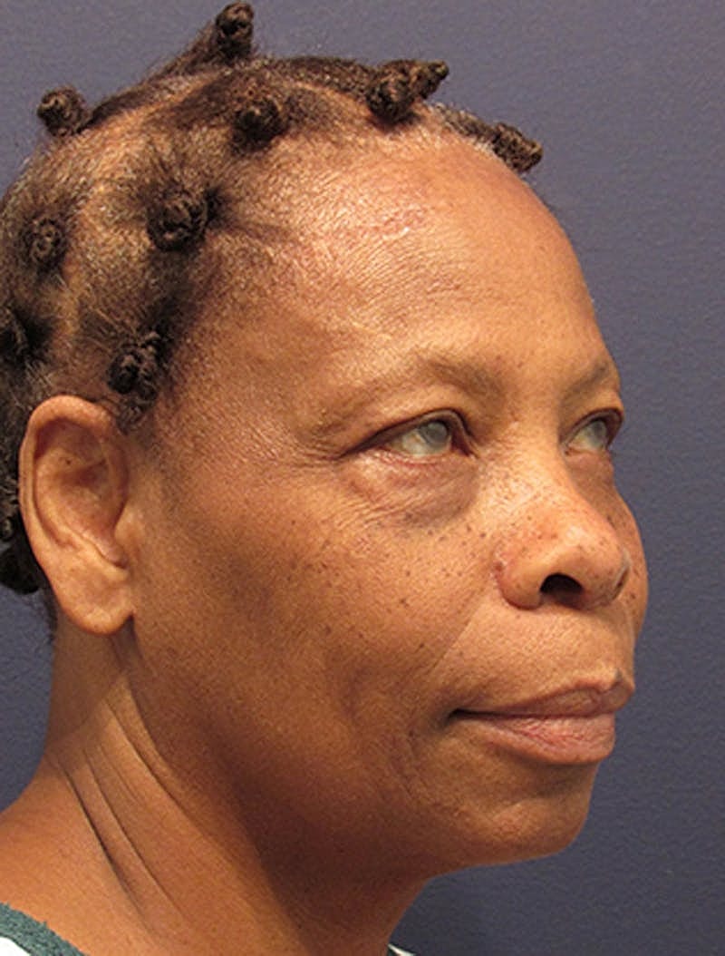 Facelift Before & After