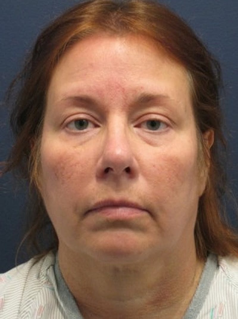 Facelift Before & After