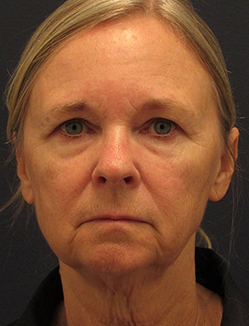 Facelift Before & After