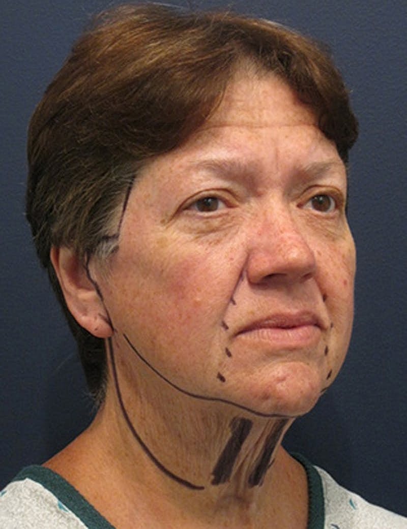 Facelift Before & After