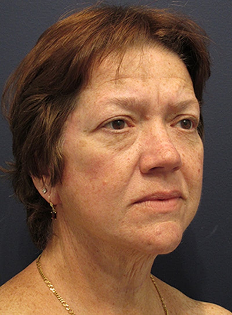 Facelift Before & After