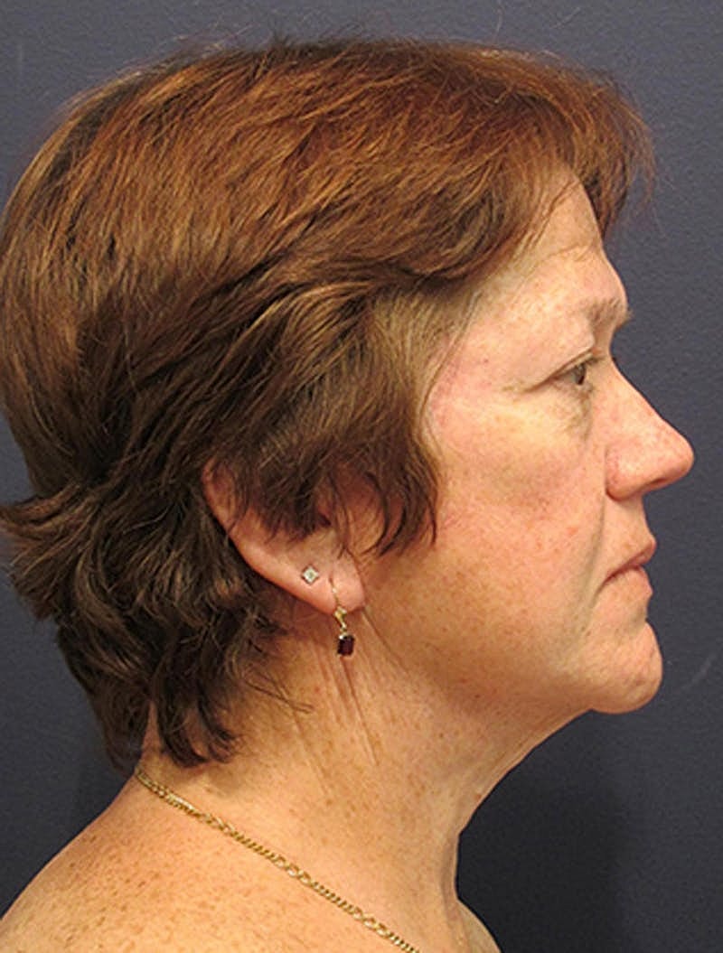 Facelift Before & After