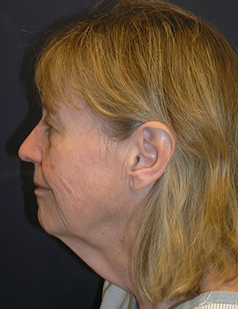 Facelift Before & After