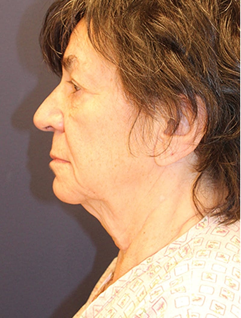 Facelift Before & After