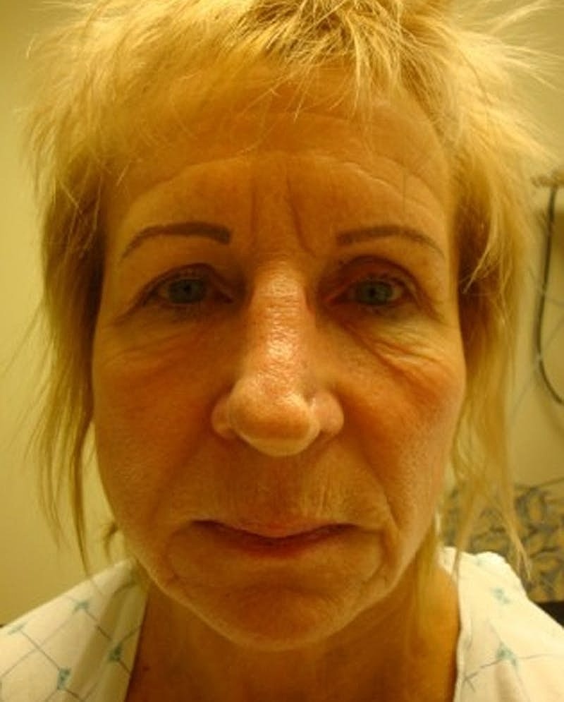 Facelift Before & After