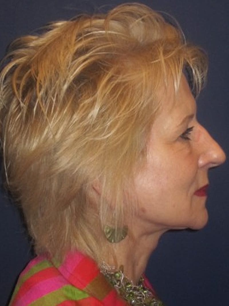 Facelift Before & After