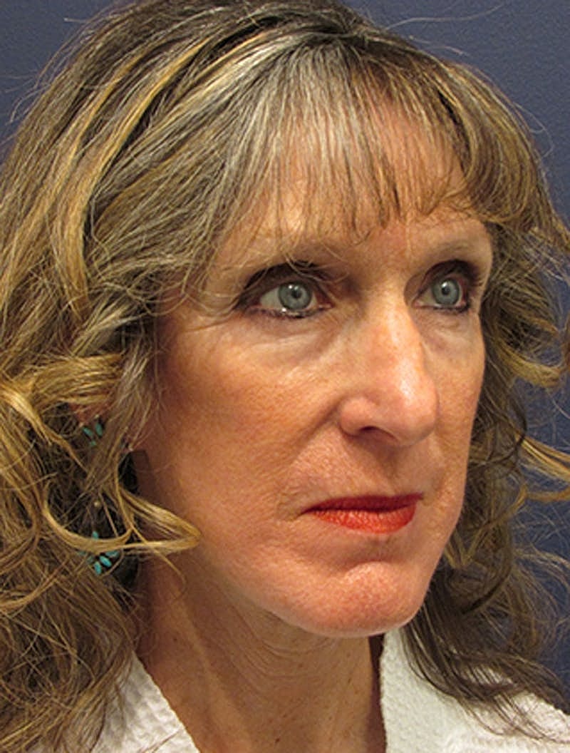 Facelift Before & After