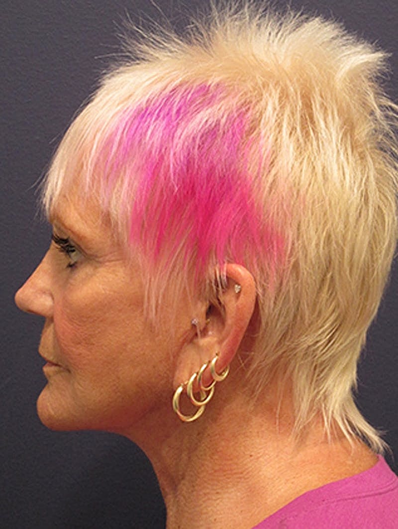 Facelift Before & After