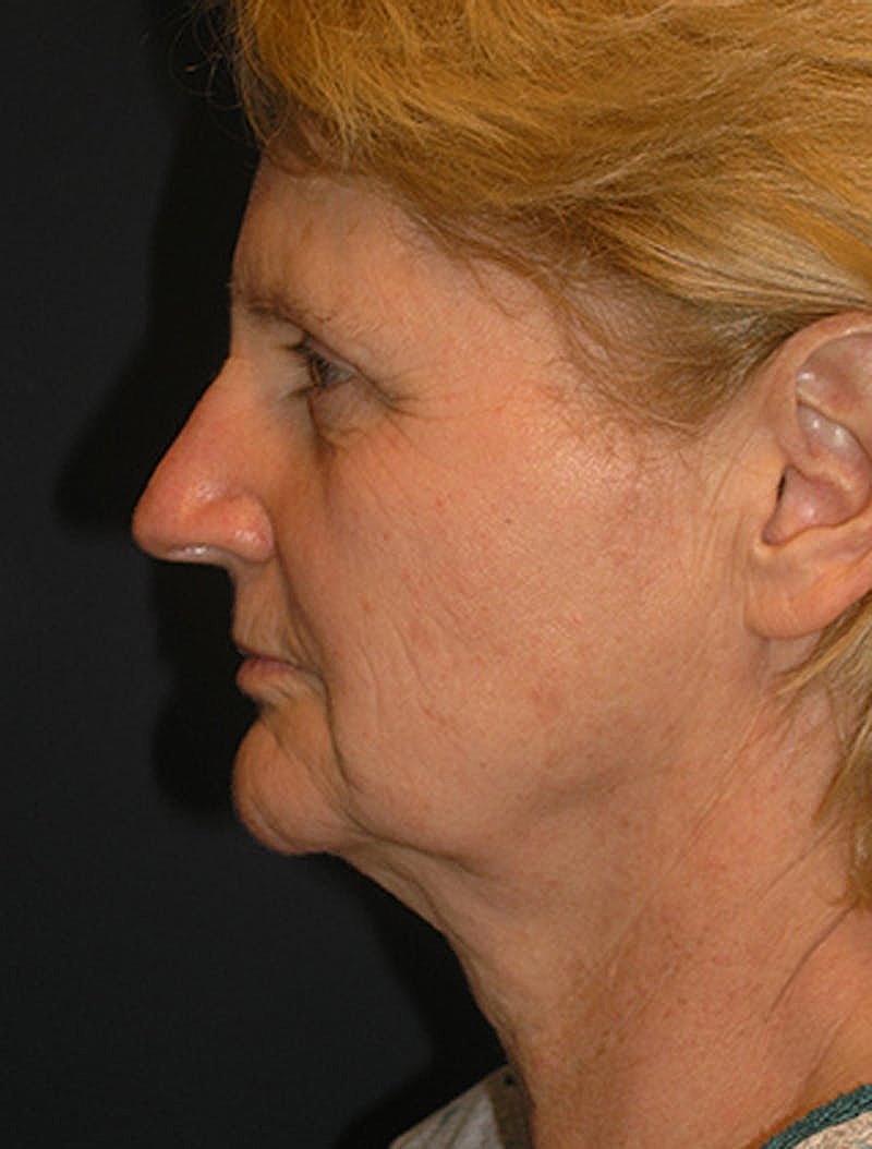 Facelift Before & After