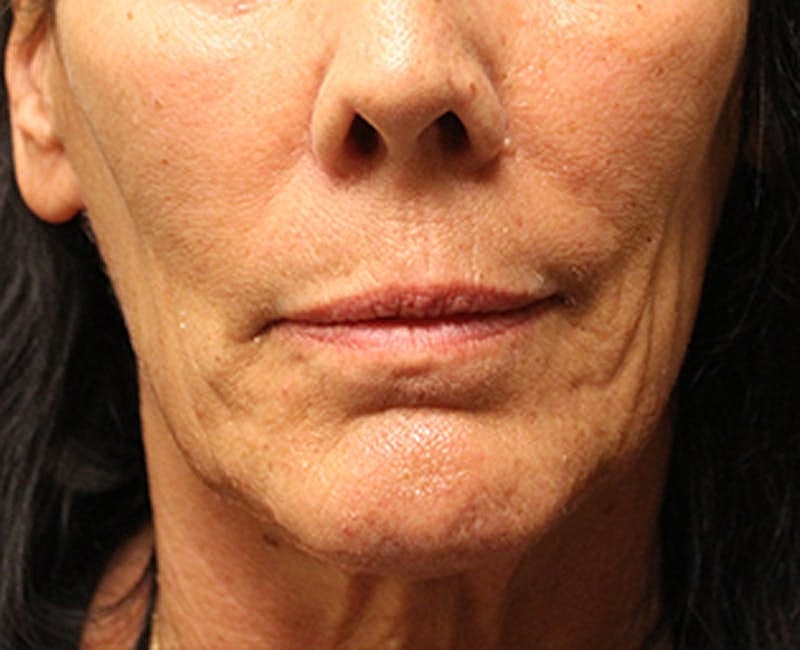 Facelift Before & After