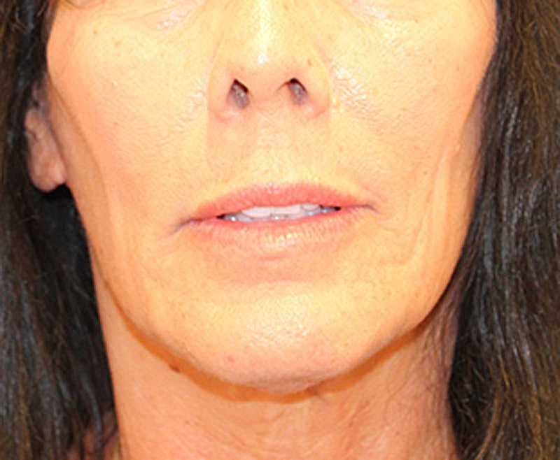 Facelift Before & After