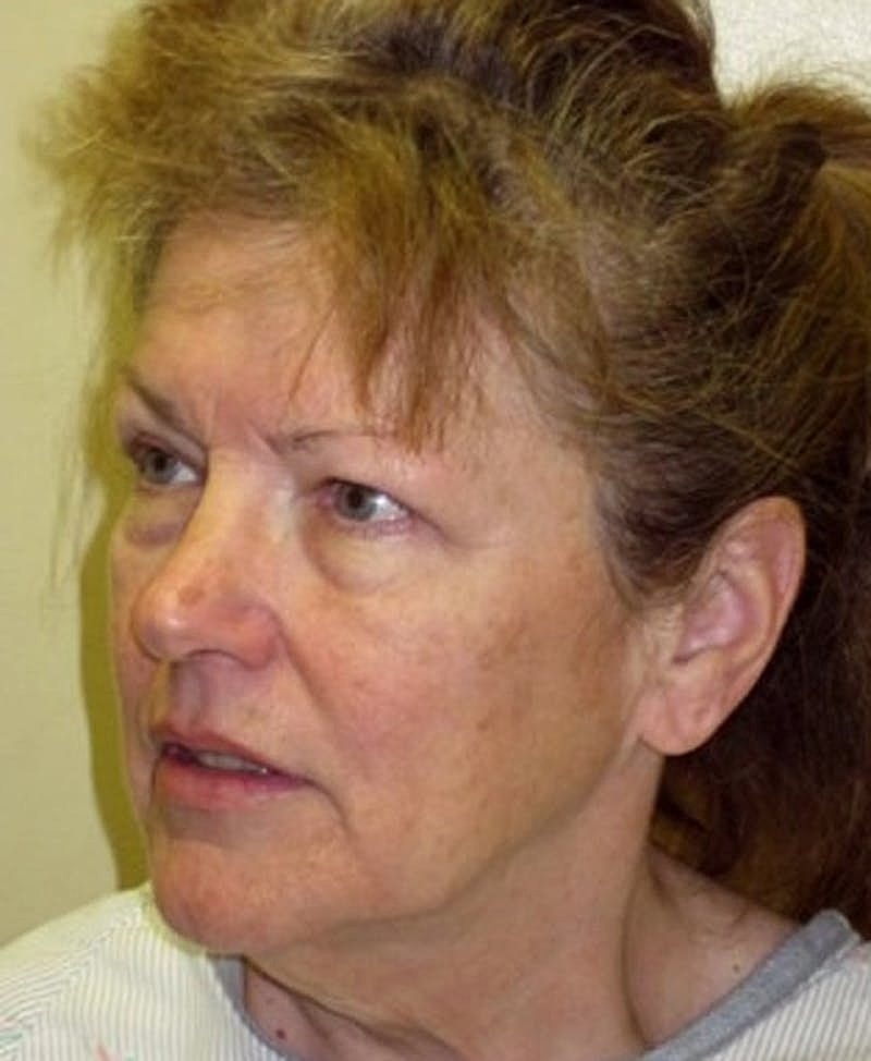 Facelift Before & After