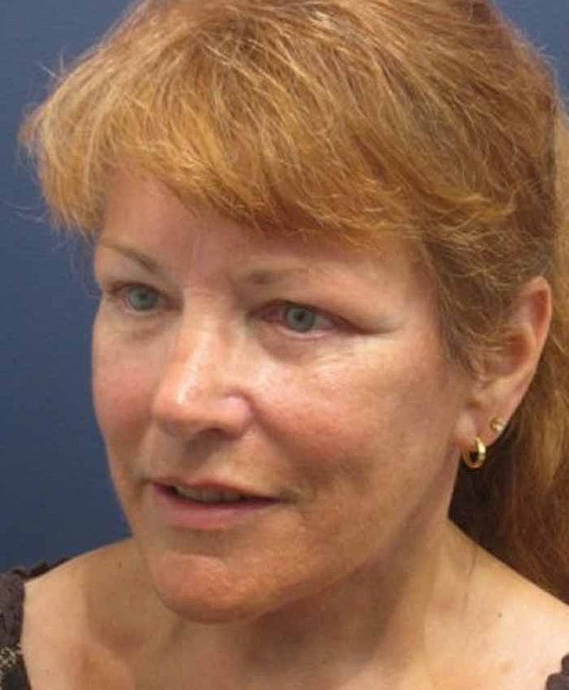 Facelift Before & After