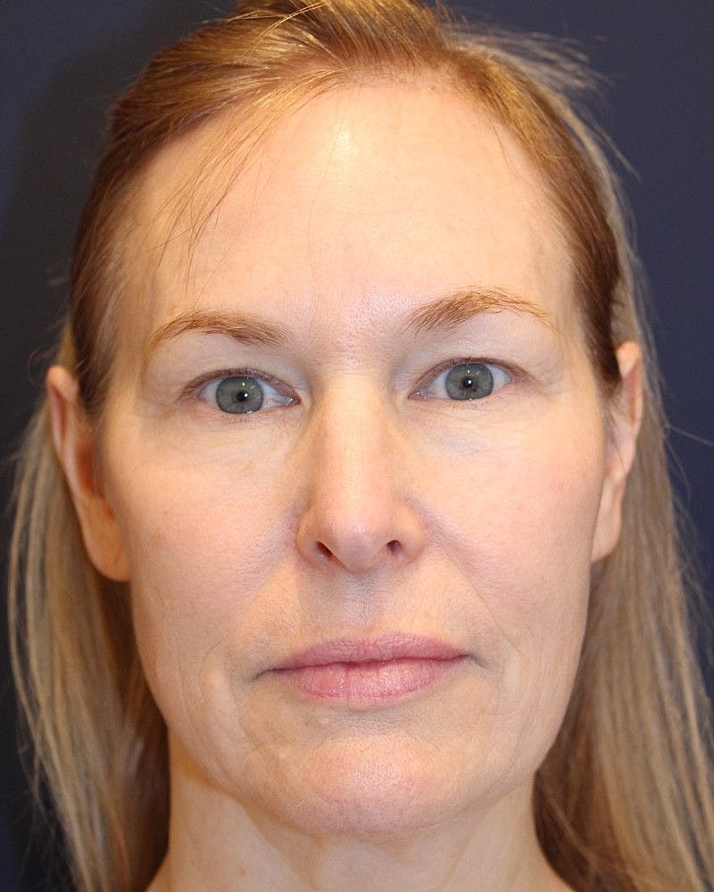 Facelift Gallery Before & After